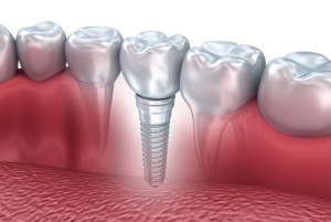 dental implant referance